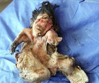 كشف جنین در شكم یك نوجوان