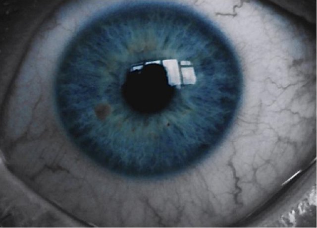 تشخیص آلزایمر از روی چشم