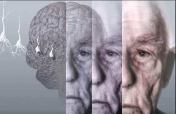کشف عامل بروز آلزایمر در نوعی اختلال چشمی