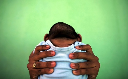 یک نوزاد 4 ماهه مبتلا به بیماری میکروسفالی(کوچک بودن مغز) در برزیل. مادر این نوزاد مبتلا به ویروس زیکا بوده است