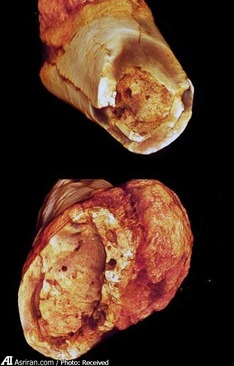 کشف رد پای ۱.۷ میلیون ساله "سرطان " در زندگی بشر(+عکس)