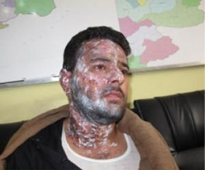 اسيدپاشي روي فيلمبردار ايراني در كابل