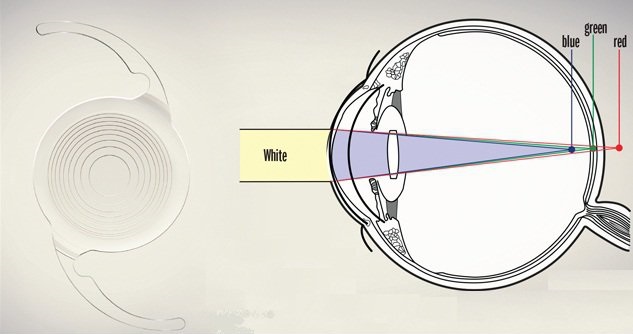 بازیابی بینایی در افراد مسن با لنز جدید