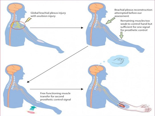 کنترل اندام مصنوعی با ذهن! کنترل اندام مصنوعی با ذهن!