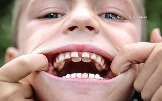 پسری با دو ردیف دندان (عکس)