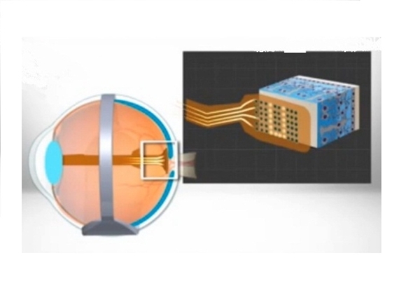زن نابینا با چشم مصنوعی بینا شد+تصاویر زن نابینا با چشم مصنوعی بینا شد+تصاویر