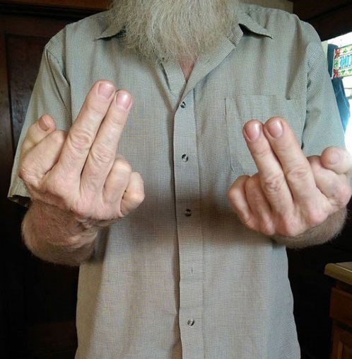 مرد 12 انگشتی! (عکس)