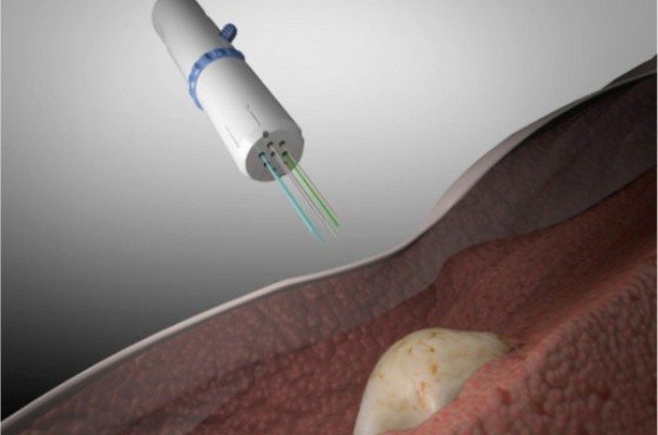 ابداع روشی نوین برای درمان سرطان سینه ابداع روشی نوین برای درمان سرطان سینه