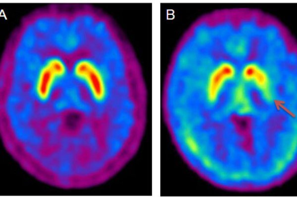 کشف دارویی امیدبخش برای درمان پارکینسون کشف دارویی امیدبخش برای درمان پارکینسون