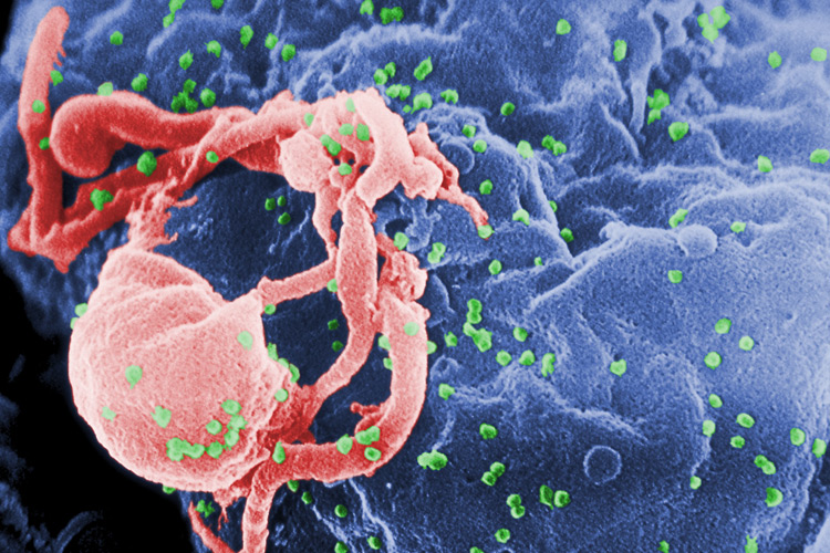 درمان ایدز با استفاده از دستکاری ژن‌ ها