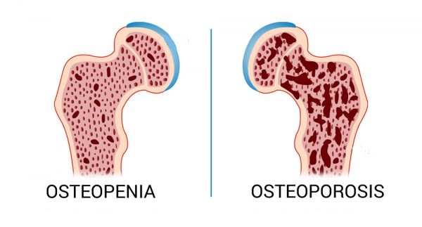 چگونگی پیشگیری از کاهش تراکم مواد معدنی استخوان چگونگی پیشگیری از کاهش تراکم مواد معدنی استخوان