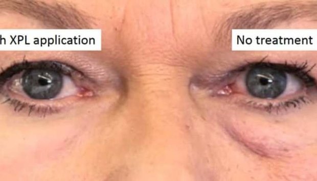 تولید پوست نامریی برای رفع چین و چروک تولید پوست نامریی برای رفع چین و چروک