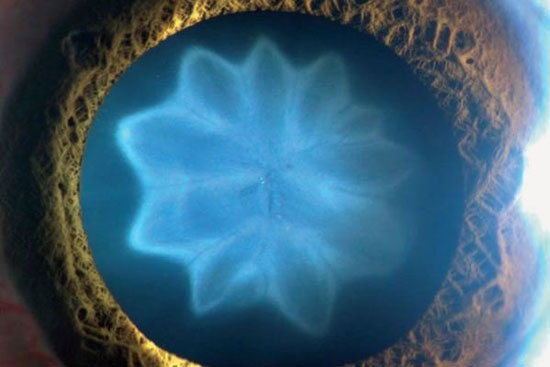 تشکیل آب مرواریدی شبیه گل در چشم! (+عکس)