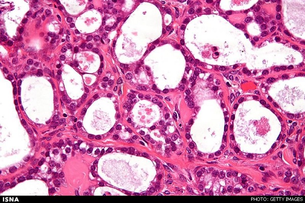 تکثیر سرطان با چاپ سه بعدی!