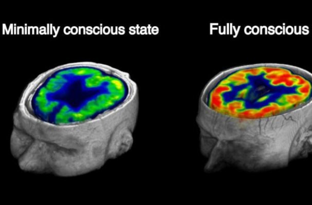 زمان بیدار شدن از کما پیش بینی می شود زمان بیدار شدن از کما پیش بینی می شود