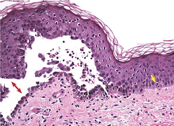 درمان تاول پوستی با داروی ضدسرطان درمان تاول پوستی با داروی ضدسرطان