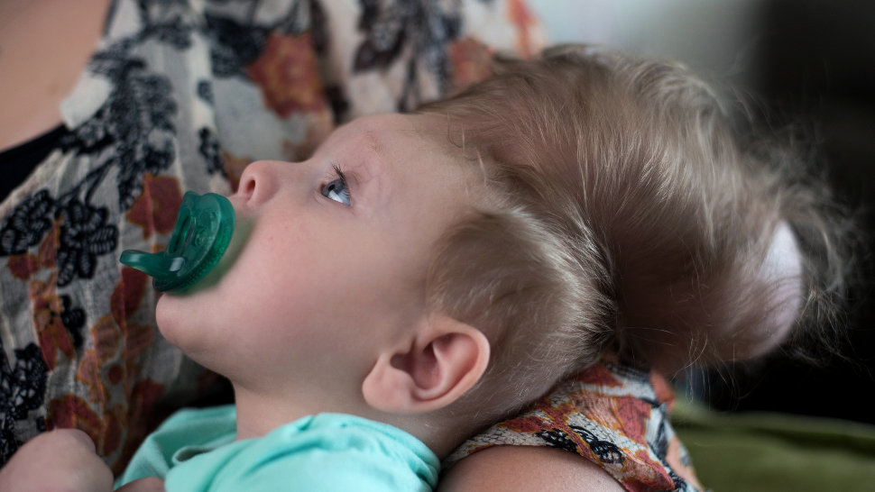 مغز بیرون زده به جمجمه بازگشت! مغز بیرون زده به جمجمه بازگشت!