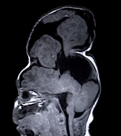 مغز بیرون زده به جمجمه بازگشت! مغز بیرون زده به جمجمه بازگشت!