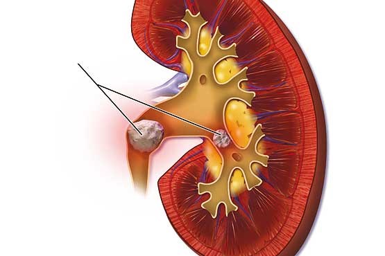امید تازه برای پیشگیری از ایجاد سنگ های کلیه امید تازه برای پیشگیری از ایجاد سنگ های کلیه