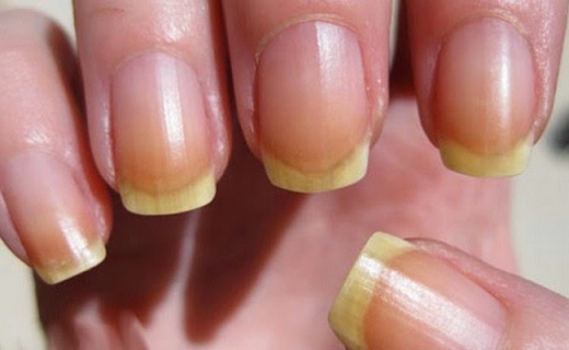 10 نشانه دریافت ناکافی مواد مغذی 10 نشانه دریافت ناکافی مواد مغذی