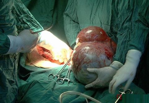 توده ۱۲ کیلوگرمی از شکم پیرزن مراغه ای خارج شد (+عکس) توده ۱۲ کیلوگرمی از شکم پیرزن مراغه ای خارج شد (+عکس)