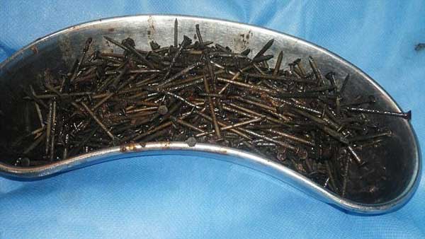 639 میخ در شکم مرد هندی! (+عکس) 639 میخ در شکم مرد هندی! (+عکس)