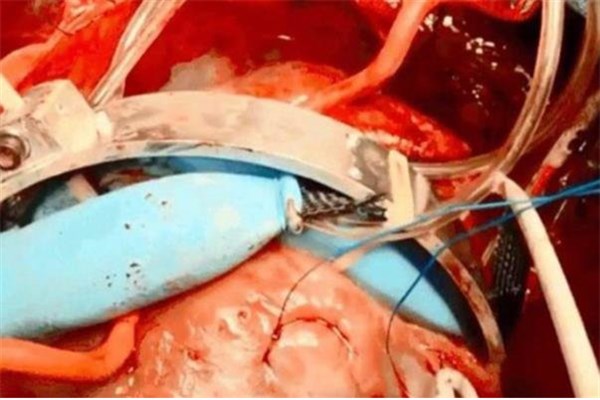 پمپ رباتیک قلب از کار افتاده را احیا می‌کند (+عکس)