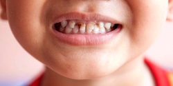 انجمن دندانپزشکان: وجود 300 میلیون دندان پوسیده در دهان ایرانیان