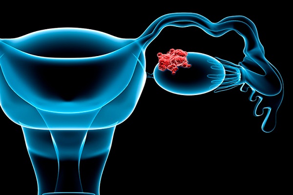 از نشانه‌های ظریف سرطان تخمدان که شاید نادیده گرفته شوند