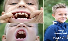 کودکی با 300 دندان در فیلیپین (عکس)