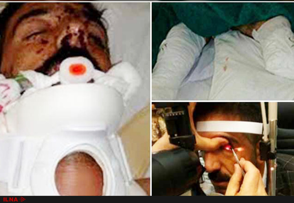 کولبر قربانی مین هیچ بیمهای ندارد/ کلیههایم را می فروشم تا هزینه عمل چشمم را جور کنم کولبر قربانی مین هیچ بیمهای ندارد/ کلیههایم را می فروشم تا هزینه عمل چشمم را جور کنم