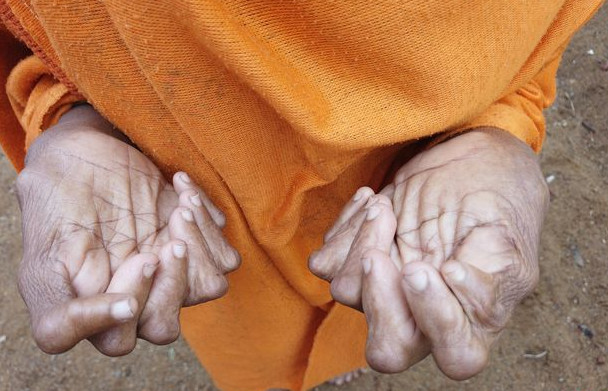 زنی با بیشترین انگشت دست و پا
