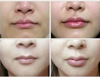 تزریق چربی چیست و چگونه انجام می شود؟ تزریق چربی چیست و چگونه انجام می شود؟