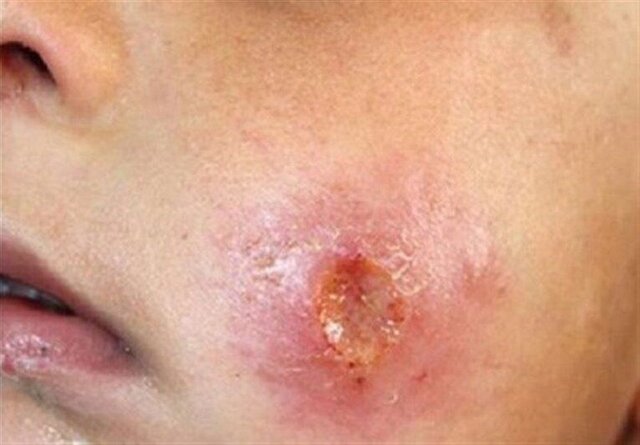 فارس/ افزایش شیوع سالک در جهرم؛ بیماران برای درمان اقدام کنند