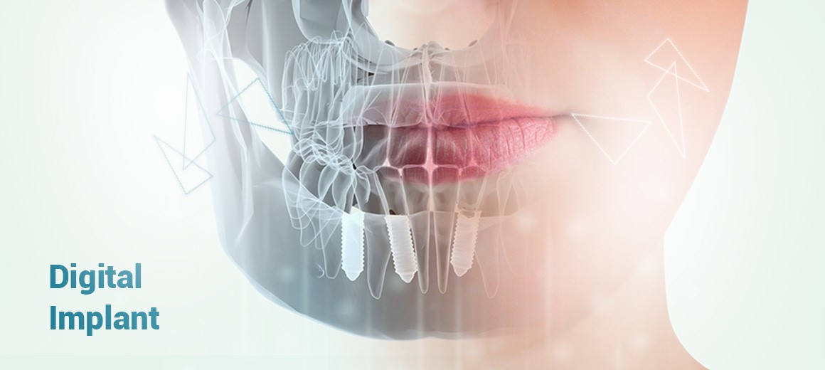 همه چیز درباره دیجیتال ایمپلنت و زیبادنت! همه چیز درباره دیجیتال ایمپلنت و زیبادنت!