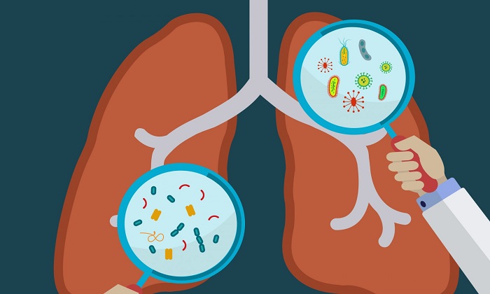 5 دلیل اصلی ابتلا به ذات الریه و چگونگی پیشگیری از آن