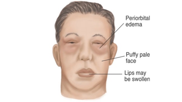هرآنچه که باید در مورد سندرم نفروتیک بدانیم