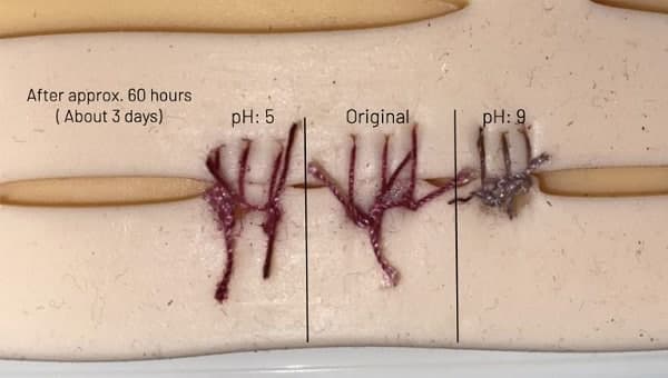یک نوجوان 17 ساله و معرفی بخیه هایی که با عفونت تغییر رنگ می دهند!(+عکس)