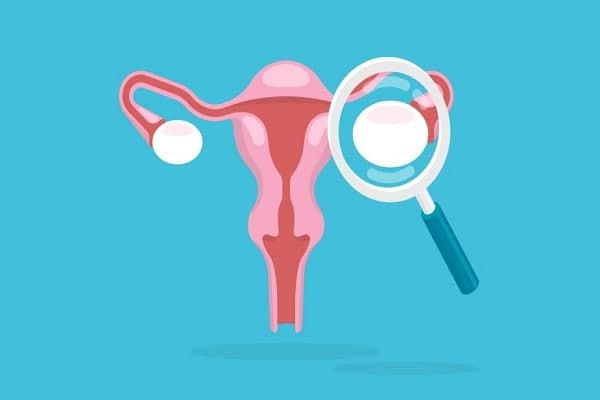 تحلیل نمره ROMA جهت تشخیص زودهنگام احتمال ابتلا به بدخیمی تخمدان تحلیل نمره ROMA جهت تشخیص زودهنگام احتمال ابتلا به بدخیمی تخمدان