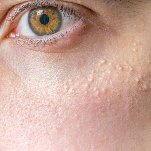 میلیا چیست؟/ علت تشکیل، گزینه ها درمانی و پیشنهاداتی برای پیشگیری از آن(+عکس) میلیا چیست؟/ علت تشکیل، گزینه ها درمانی و پیشنهاداتی برای پیشگیری از آن(+عکس)