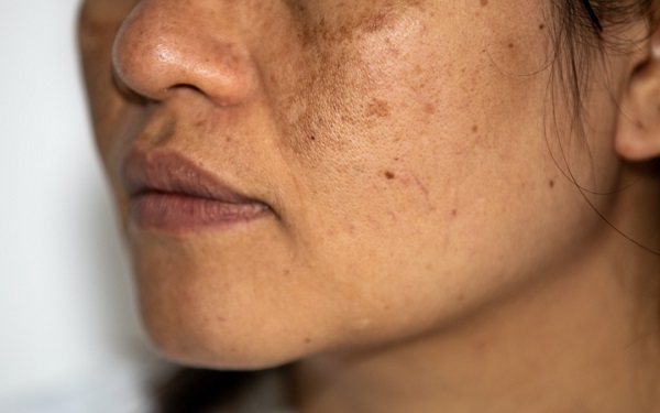 ملاسما؛ یک بیماری پوستی از ابتلا تا درمان (+عکس) ملاسما؛ یک بیماری پوستی از ابتلا تا درمان (+عکس)