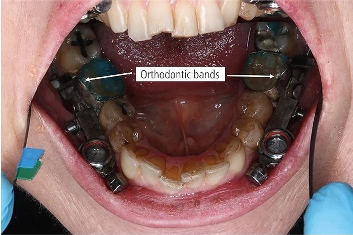 کاهش وزن با دستگاهی که فک را قفل می کند! کاهش وزن با دستگاهی که فک را قفل می کند!