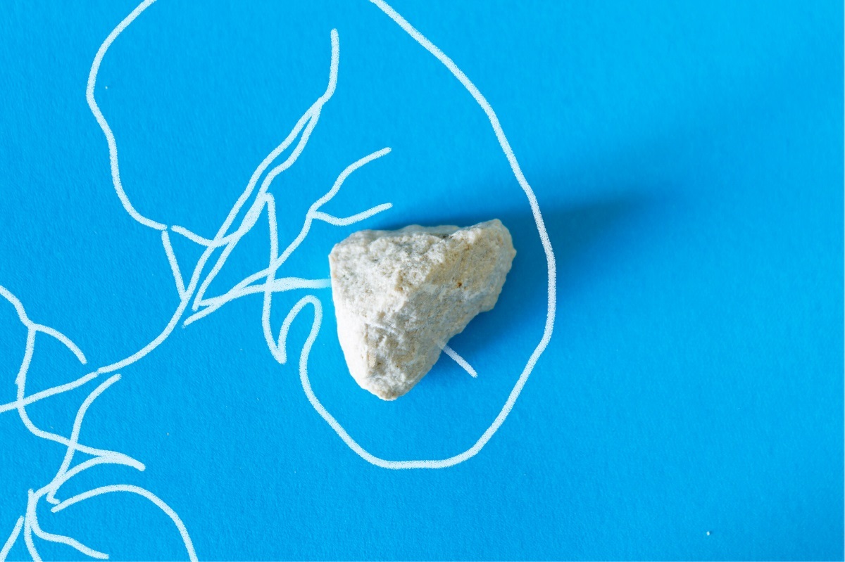 از آب لیمو تا ترکیبات طبیعی موثر برای انهدام سنگ های کلیوی