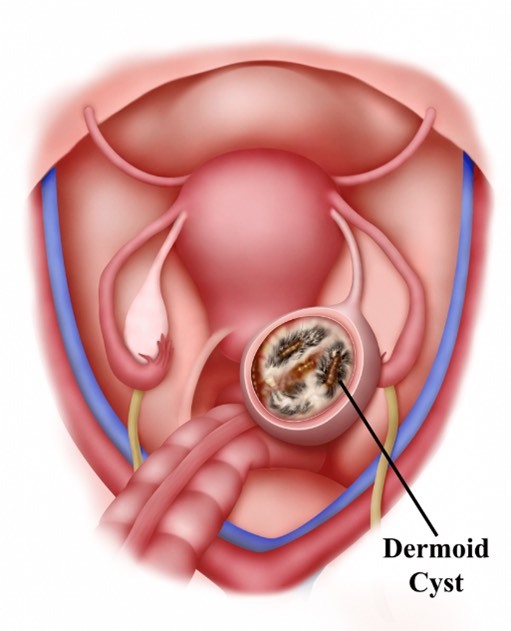 از سیر تا پیاز کیست درموئید