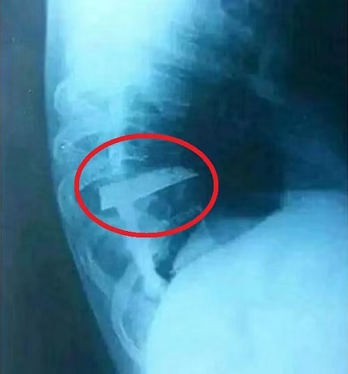 مرد الجزایری ۲۵ سال با خنجری در پهلو زندگی کرد (+عکس)