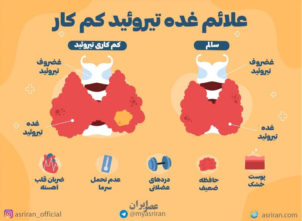 علائم تیروئید کم کار (اینفوگرافیک)