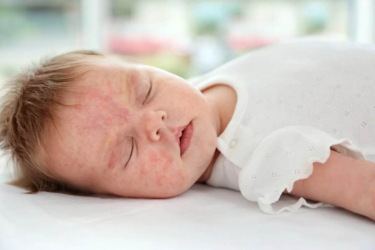 توصیه‌هایی درباره حساسیت به شیر در نوزادان