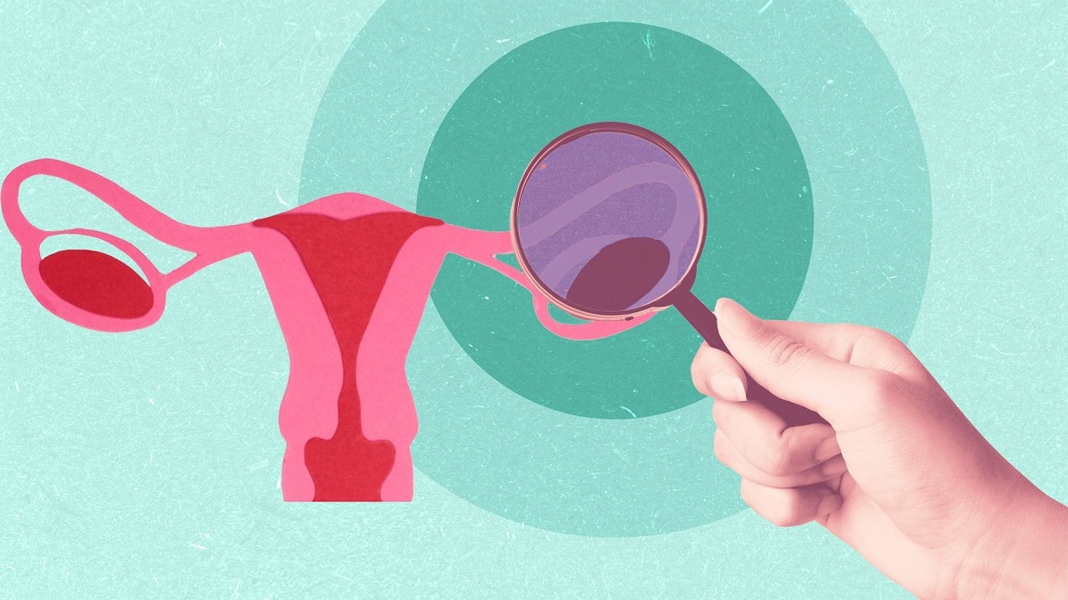 خانم ها بخوانند: نقش مهم ویتامین D در جلوگیری از سرطان تخمدان