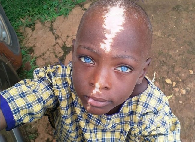 چهره این کودک شهرت جهانی دارد/ رعد و برق در وسط صورتش! + عکس