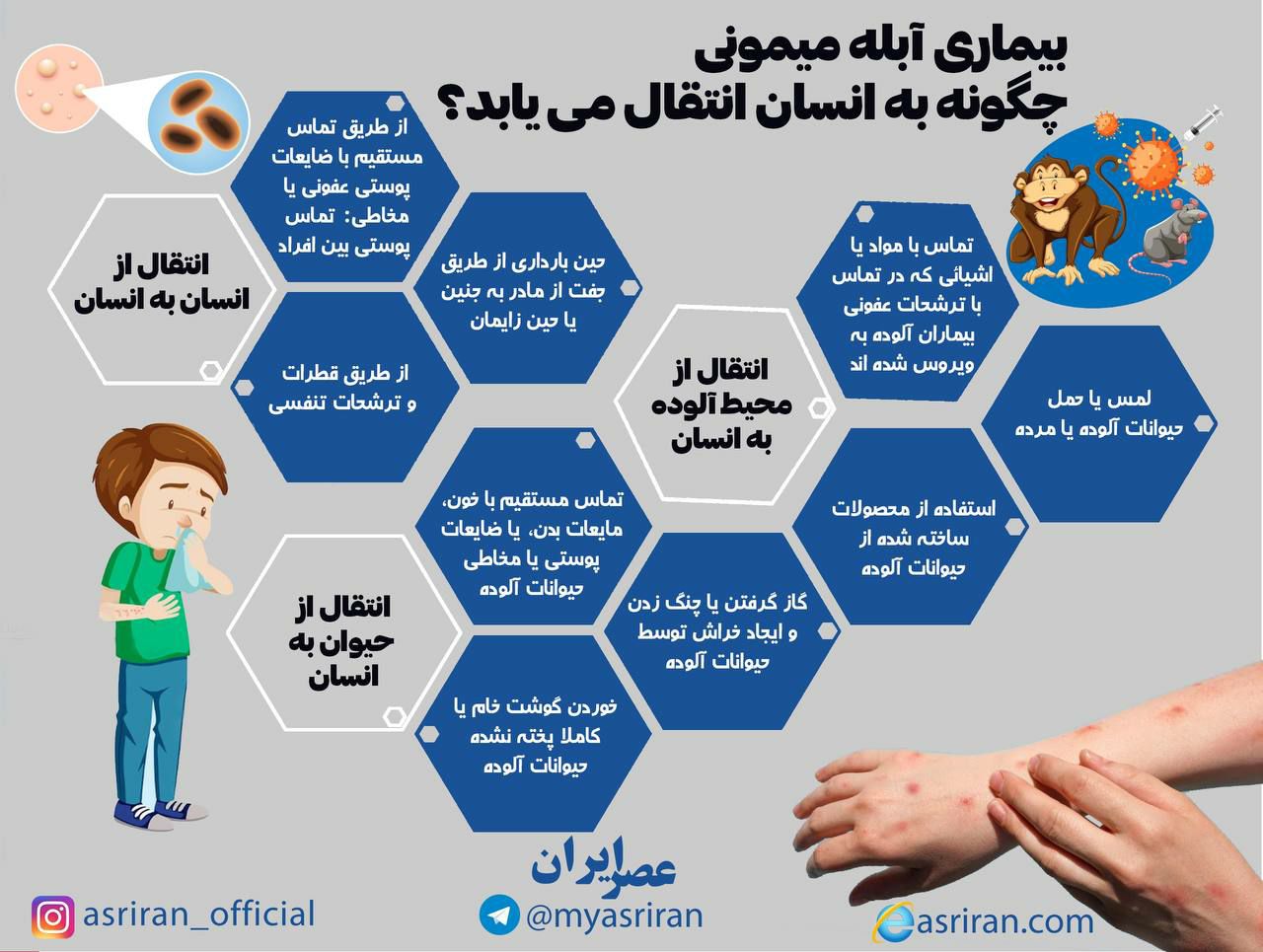 بیماری آبله میمونی چگونه به انسان منتقل می یابد؟ (اینفوگرافیک)